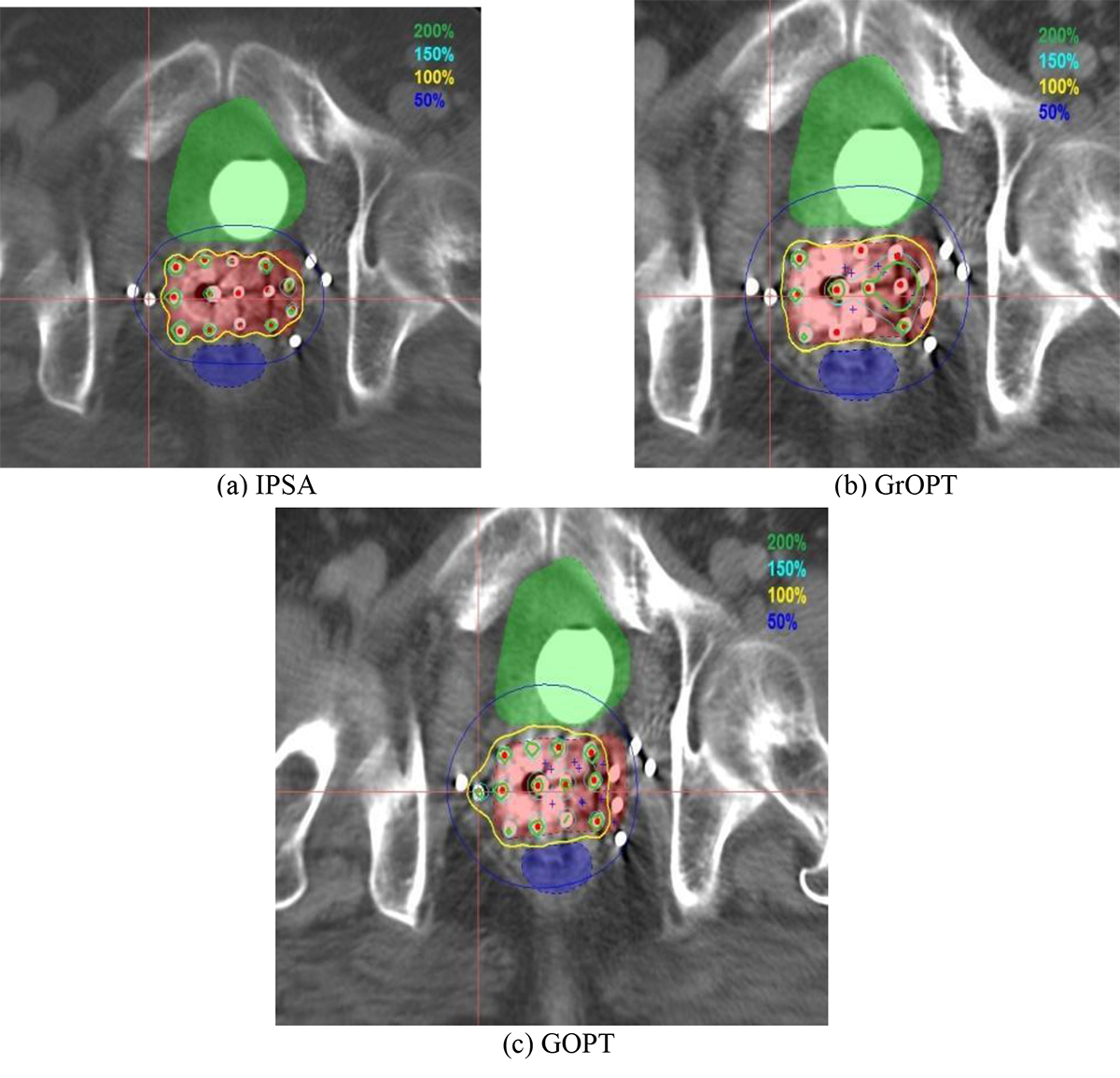 A, Patient simulated with a radiation bra. B, The geometrical