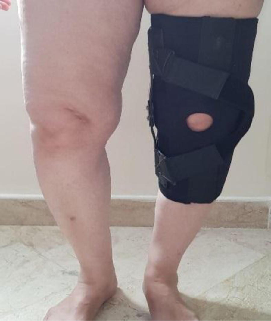 Comparison of Immediate Effect of New Knee brace and Conventional  Three-Points Knee Valgus Brace on Knee Adduction Moment and ROM in Patients  with Medial Knee Osteoarthritis