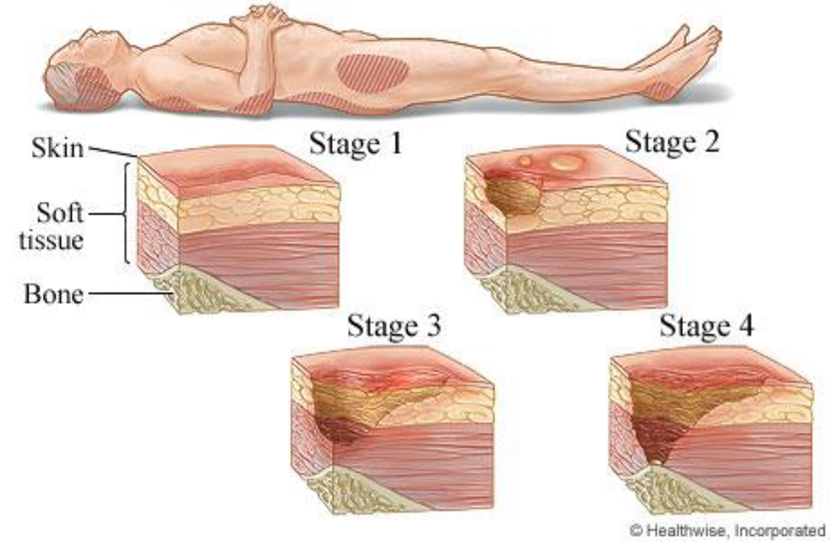 The schematic of the novel doublelayered wavy mattress, a: air (A) 